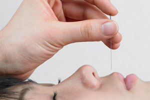 Yin, Yang und eine Nadel: Was Akupunktur wirklich bringt