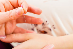 Wie Akupunktur beim Kinderwunsch helfen kann