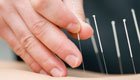 Akupunktur: Wie wirkt die natürliche Heilmethode?