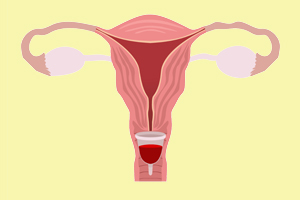 Die Menstruationstasse sitzt unter dem Muttermund. 